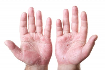 eczema sur les mains