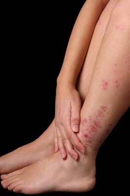 psoriasis et taches rouges